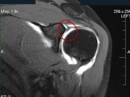 Left superior labral tear extending along the posterior superior quadrant